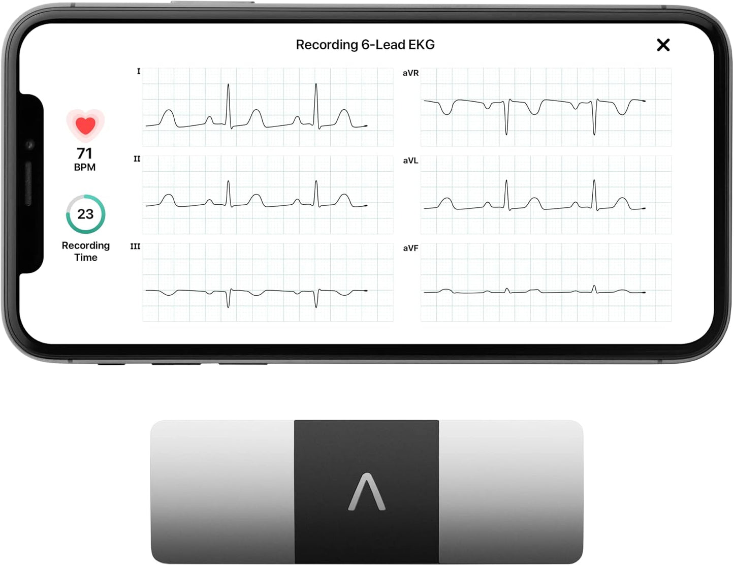 Kardiamobile 6-Lead Personal EKG Monitor - Comprehensive Heart Monitoring with Afib and Irregular Arrhythmia Detection - Instant Results in 30 Seconds - Compatible with Most Smartphones - FSA/HSA Eligible